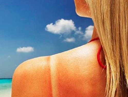 Sunburn girl
